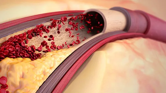 Разработана иммунотерапия, очищающая артерии от холестериновых бляшек