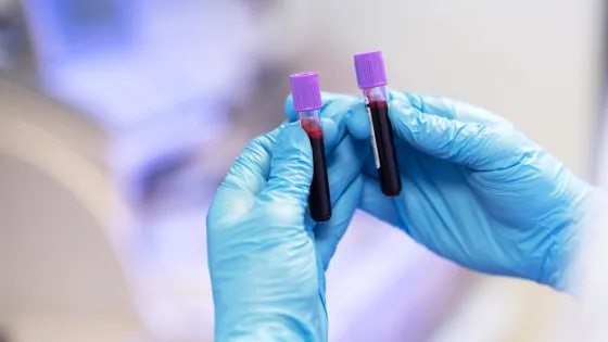 Анализ крови повышает точность диагностики болезни Альцгеймера на ранней стадии до 95%