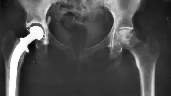 Hip_replacement_Image_3684-PH-1--scaled-v1