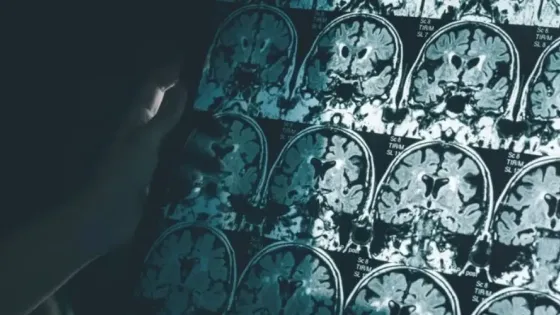 Таблетки от болезни Альцгеймера сохраняют объем мозга