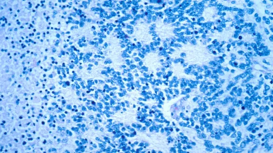 Neuroblastoma_rosettes-1-1-2