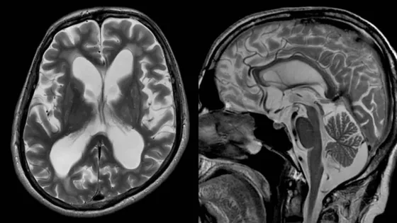 hydrocephaly-mri