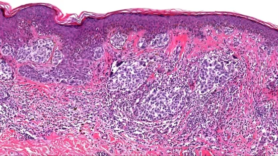skintumormelanocyticmelanomadonati12-1-1--v1