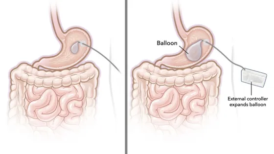 MIT-Gastric-Balloon-01-press_0-v1