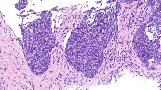 Non-small_cell_lung_carcinoma_-_intermed_mag