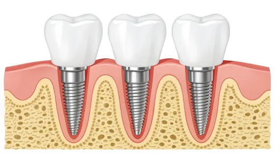 dental-implants-to-draw