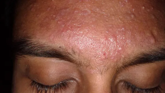 Acne_vulgaris_on_a_very_oily_skin-scaled-v1