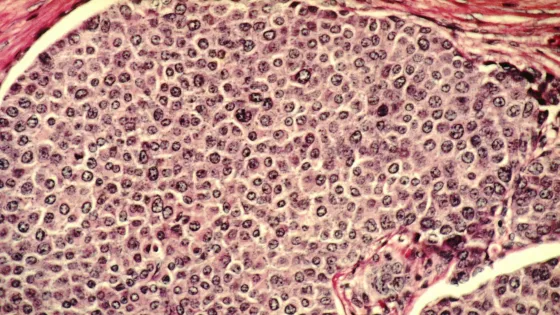 Breast_cancer_cells-1-scaled