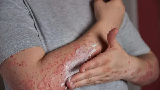 applying-moisturizer-skin-with-psoriasis-scaled