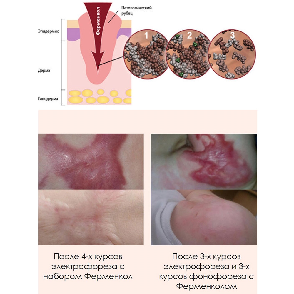 Ферменкол комплект для энзимной коррекции 4 мг. / 40 мл.