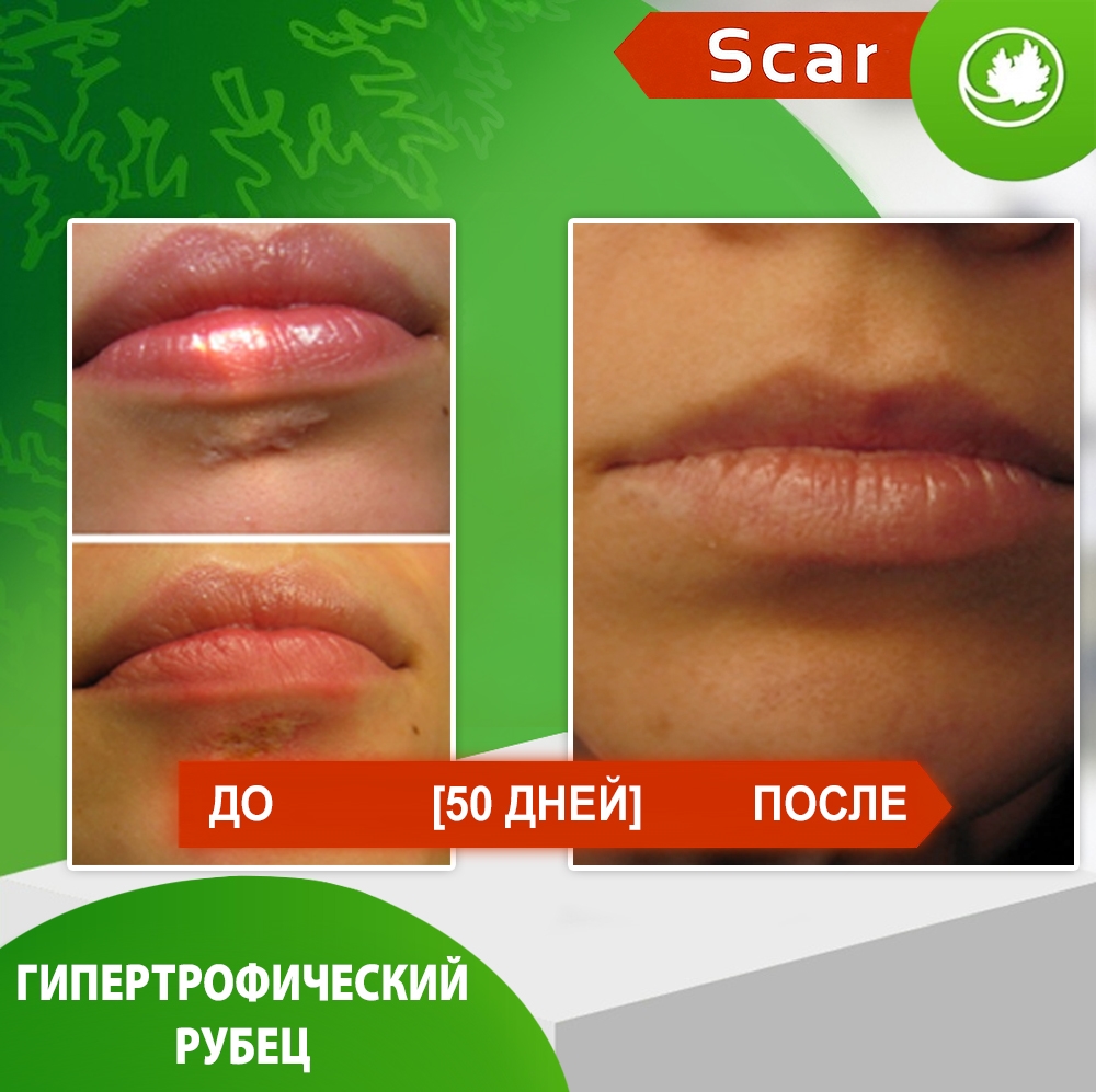 Карипаин Scar гель ферментный для кожи с Коллагеназой и Тизолем 40 мл.