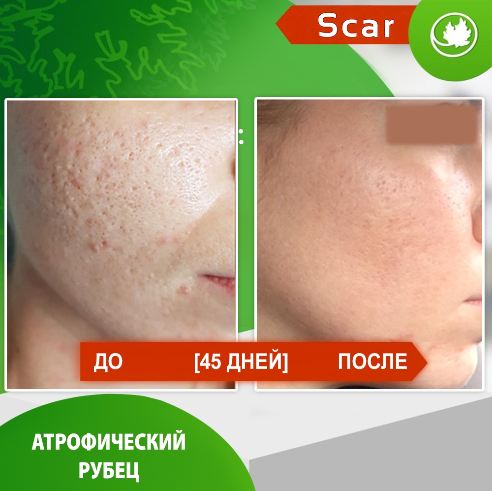 Карипаин Scar гель ферментный для кожи с Коллагеназой и Тизолем 40 мл.