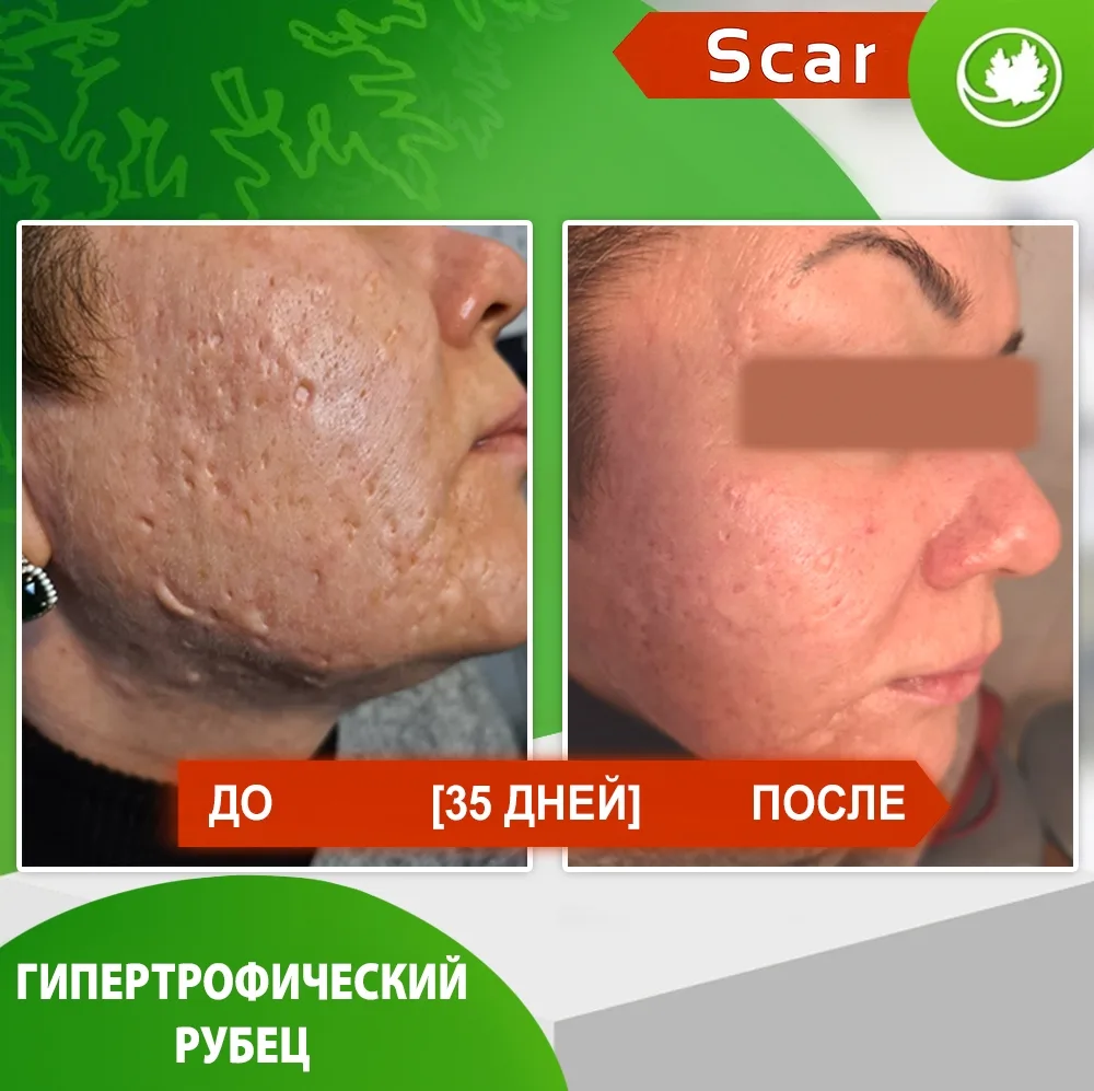 Карипаин Scar гель ферментный для кожи с Коллагеназой и Тизолем 12 мл