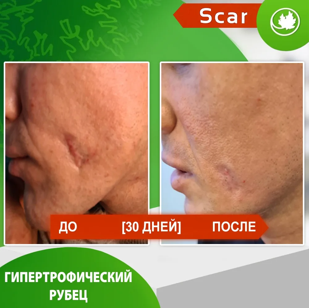 Карипаин Scar гель ферментный для кожи с Коллагеназой и Тизолем 12 мл
