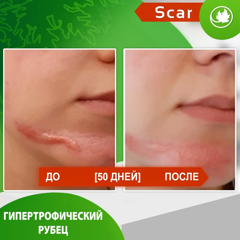 Карипаин Scar гель ферментный для кожи с Коллагеназой и Тизолем 12 мл