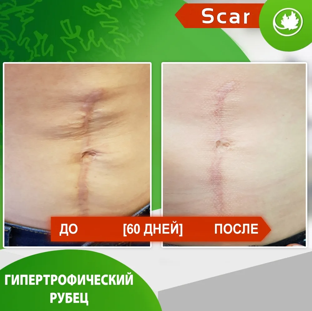Карипаин Scar гель ферментный для кожи с Коллагеназой и Тизолем 12 мл
