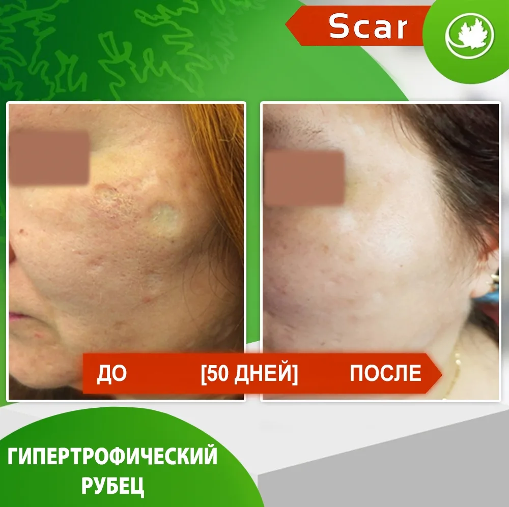 Карипаин Scar гель ферментный для кожи с Коллагеназой и Тизолем 12 мл