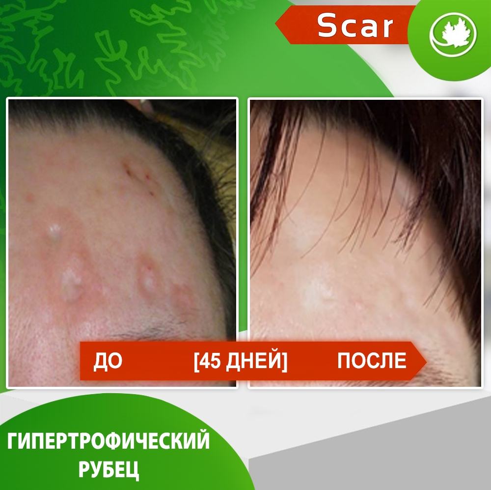 Карипаин Scar гель ферментный для кожи с Коллагеназой и Тизолем 12 мл.