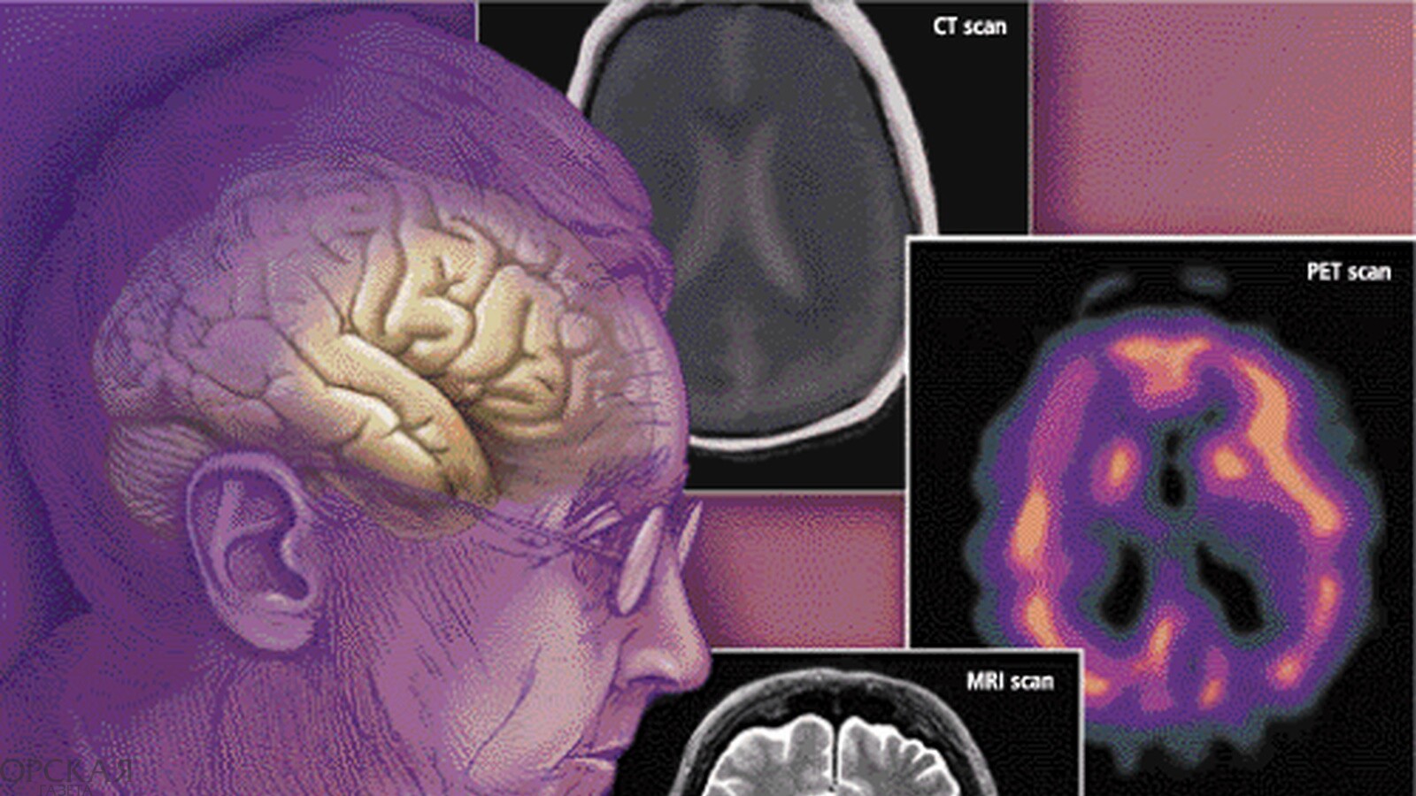 Деменция головы. Дисциркуляторная деменция. Лобно-височная деменция. Деменция сосудов головного мозга. Болезнь Альцгеймера.