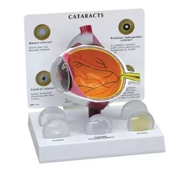 Медицинская модель катаракты глаза ciiizaoo
