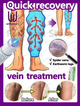 Проблемы с венами Нанотерапия