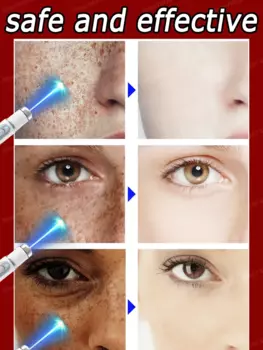 Веснушки, мелазма, мелазма, темные пятна на лице, Blu-Ray pen