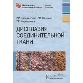 Дисплазия соединительной ткани