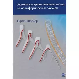 Эндоваскулярные вмешательства на периферических сосудах