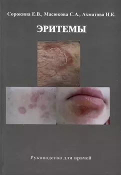 Эритемы. Руководство для врачей