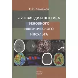 Лучевая диагностика венозного ишемического инсульта