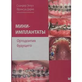 Мини-имплантаты. Ортодонтия будущего.