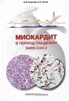 Миокардит в период пандемии SARS-CoV-2
