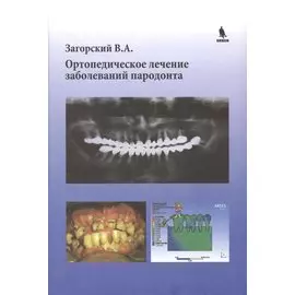 Ортопедическое лечение заболеваний пародонта