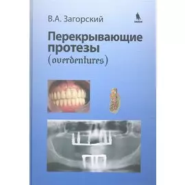 Перекрывающие протезы (overdentures)