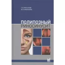 Полипозный риносинусит