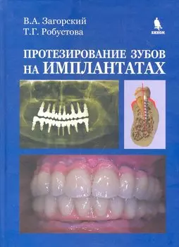 Протезирование зубов на имплантатах.