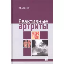 Реактивные артриты