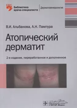 Атопический дерматит