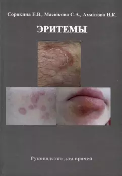 Эритемы. Руководство для врачей