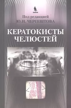 Кератокисты челюстей.