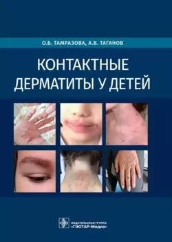 Контактные дерматиты у детей