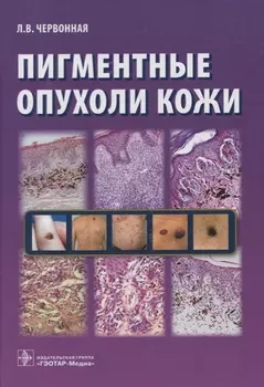 Пигментные опухоли кожи