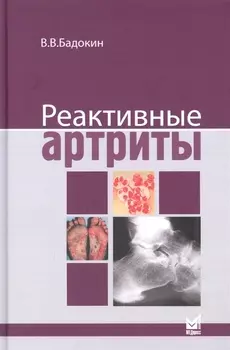 Реактивные артриты