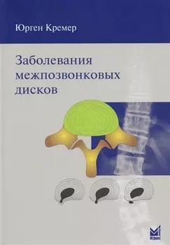 Заболевания межпозвонковых дисков