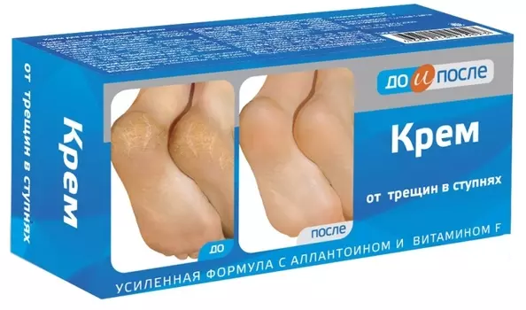 до и после крем от трещин в ступнях 150 мл