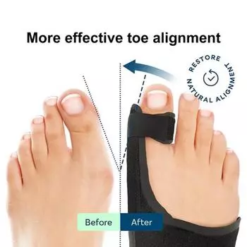 1 пара корректоров косточки большого пальца ноги, выпрямитель, разделитель, регулируемая шина для косточки большого пальца ноги при вальгусной деформации большого пальца ноги, удобная, дышащая, обезболивающая чёрный