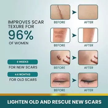 1 рулон силиконовых пластырей для рубцов, гелевый пластырь для рубцов 4 см x 150 см, самоклеящаяся лента для покрытия рубцов, многоразовые и эффективные полоски для ухода за кожей one size