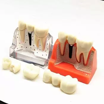 1 шт., 4 раза, обучение обучению зубов, модель, анализ заболеваний зубного имплантата с реставрацией, демонстрация короночного моста 1 piece Red