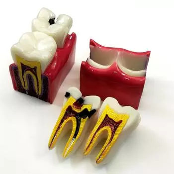 1 шт., модель зубов для обучения анатомии зубов, 6 раз, модели для сравнения кариеса для обучения и исследований стоматолога 1 piece A