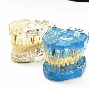 1 шт., модель зубов с заболеванием зубного имплантата с реставрационным мостом, зубной стоматолог для медицинской науки, обучающее исследование стоматологических заболеваний 1 piece clear